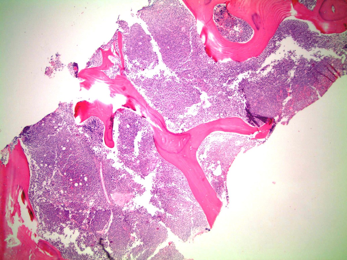 Bone marrow biopsy 40X